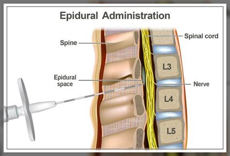 Epidural Injection: What is it, Procedure, and More - Engiomed