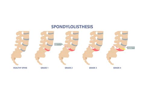 Spondylolisthesis | Chibuikem Akamnonu, MD