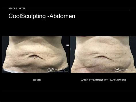 Before & After Photos Of Coolsculpting Treatment Results