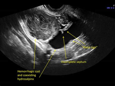 Hemorrhagic Cyst Ultrasound