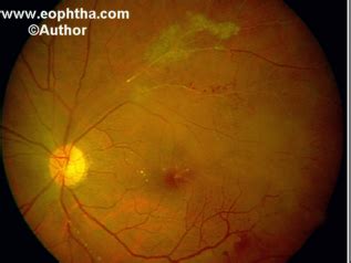 Retinal Vasculitis