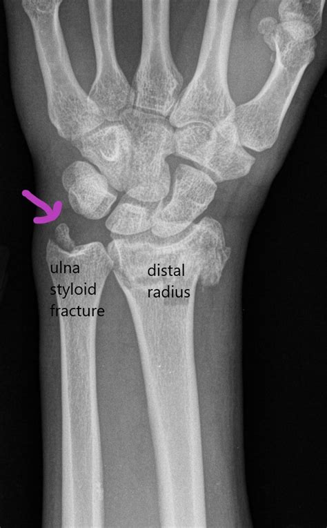Ulnar Sided Wrist Pain, TFCC tear, wrist band - plantecuador.com