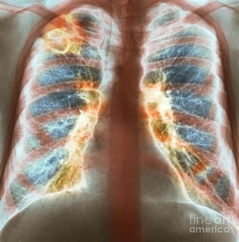 Drug Use Lung Damage, X-ray Photograph by Spl