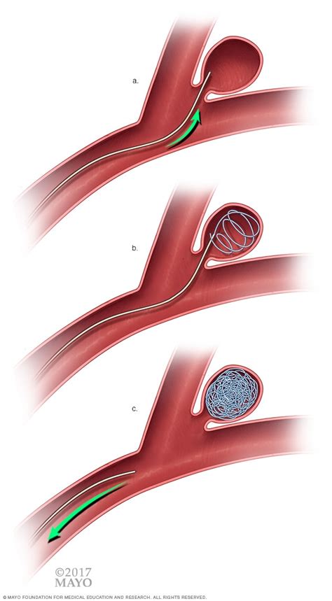 Brain Aneurysm Repair Surgery