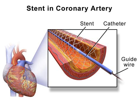 Stent - Wikipedia