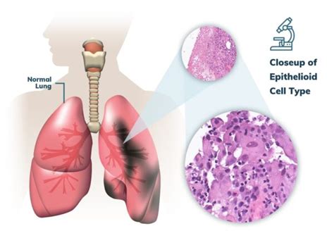 Pleural Mesothelioma Pleural Mesothelioma - Babies Daily News