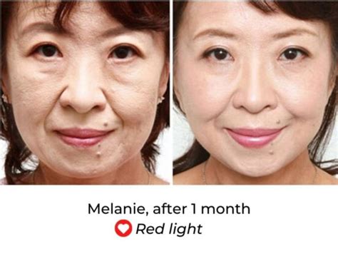 LED Face Mask Before And After - MyLEDtherapy - LED Light Therapy ...