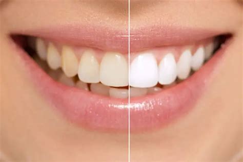 How To Whiten Your Teeth With Baking Soda - 7 Best Ways