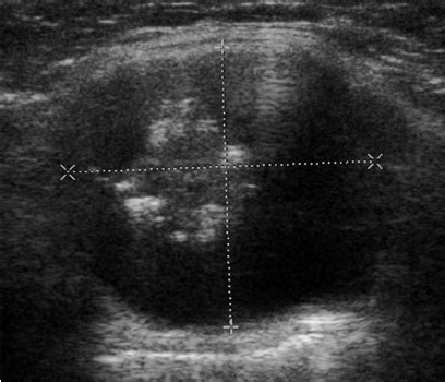 Ultrasound scan of thyroglossal duct cyst with central solid component. | Download Scientific ...