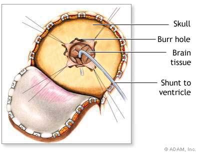 The New York Times > Health > Image > Craniotomy for Cerebral Shunt