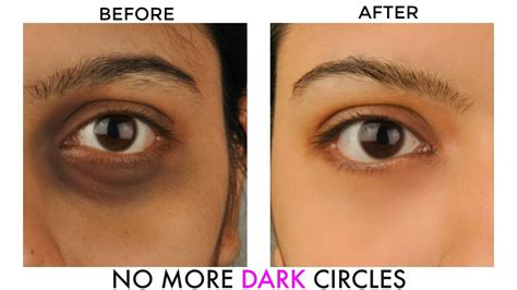 Dark Circles Treatment Dubai - Laser Skin Care Clinic Dubai