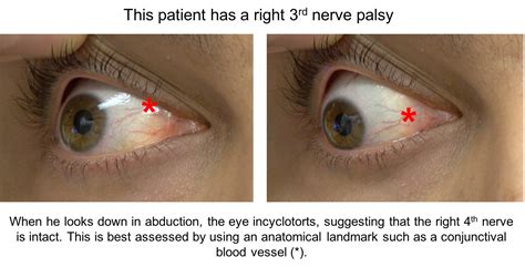 Trochlear Nerve Palsy Eye Position