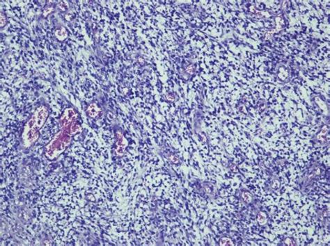 Hemangiosarcoma-Non-descript-Grey brown, irregular round, ulcerated ...