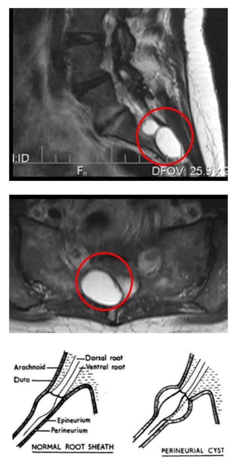 Tarlov Cyst - Excel Spine