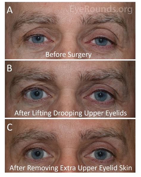 Atlas Entry - Cosmetic Correction of Secondary Upper Eyelid Dermatochalasis After Upper Eyelid ...