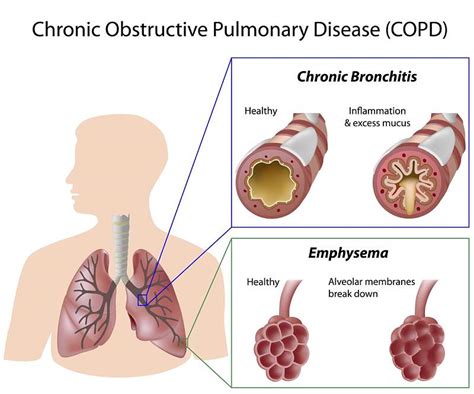 The many inflammatory faces of chronic obstructive pulmonary disease (COPD) cannot be diagnosed ...