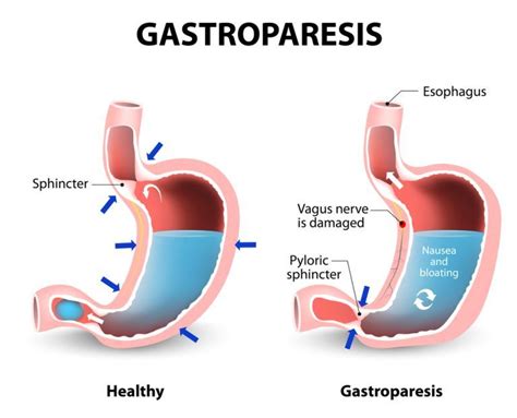 HOW IS GASTROPARESIS DIAGNOSED? | Gastroparesis treatment ...