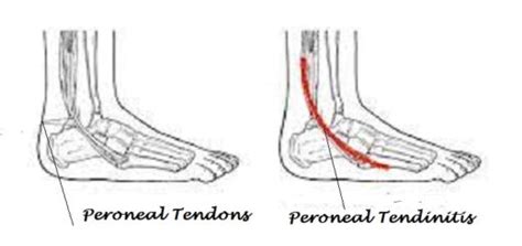 Peroneal Tendonitis - Best Shoes Reviews