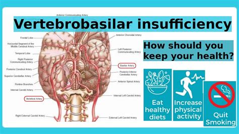 vertebrobasilar insufficiency - YouTube