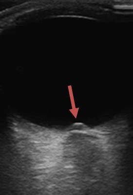 Optic Nerve Sheath ultrasound | STROKE MANUAL