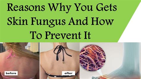 Reasons Why You Gets Skin Fungus And How To Prevent It - YouTube