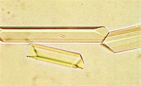 variation in Triple phosphate crystals | Medical Laboratories