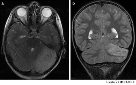 Acute cerebellitis in paediatric patients: Our experience | Neurología (English Edition)