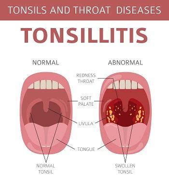 Signs of Tonsillitis