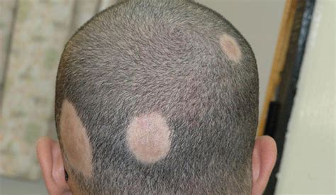 What is Alopecia? Types & Causes Explained