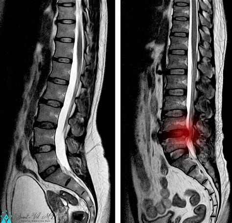 MRI Lumbar spine scan sagittal view Lumbosacral spine has straightening lumbar alignment ...