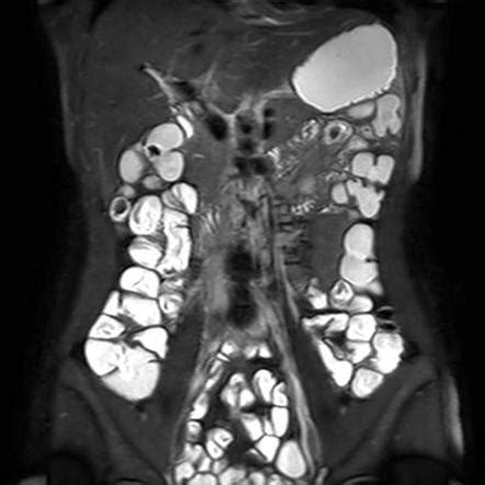 MR enterography | Radiology Reference Article | Radiopaedia.org