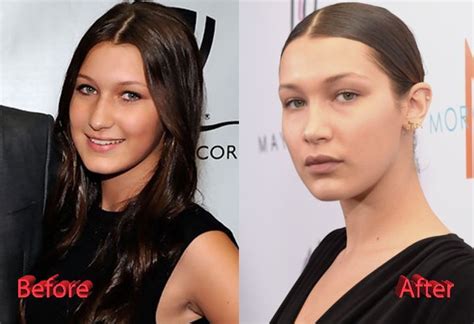 Bella-Hadid-Plastic-Surgery-Before-and-After: lips injections and nose ...