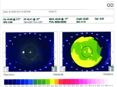 Postoperative corneal topography map of the right eye. | Download Scientific Diagram