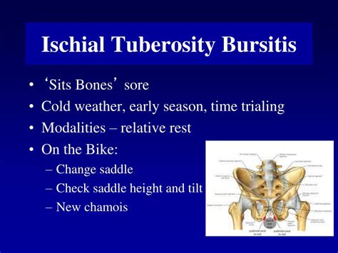 Ischial Tuberosity Bursitis