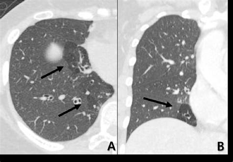 Pattern approach of mosaic attenuation: Radiological anatomy and strategy for differentiation ...