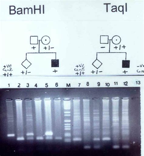 BamHI and TaqI, RFLP gel electrophoresis BamHI was informative for this ...