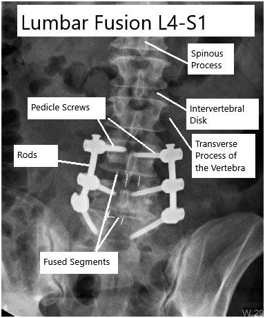 Lumbar Fusion Surgery - Complete Orthopedics | Multiple NY Locations