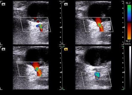 Femoral artery pseudoaneurysm | Radiology Reference Article | Radiopaedia.org