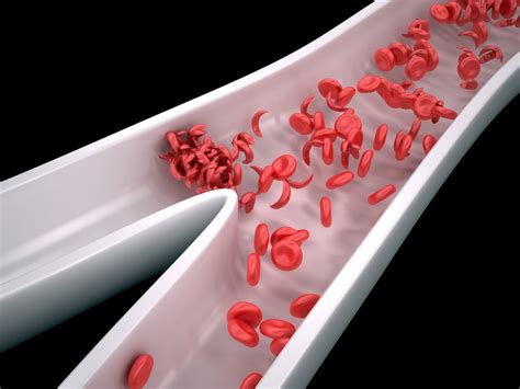 10 Symptoms of Sickle Cell Anemia - Facty Health