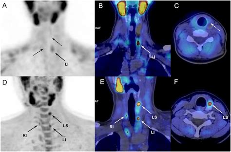 Discordant results of 99mTc-sestamibi parathyroid scintigraphy (upper... | Download Scientific ...