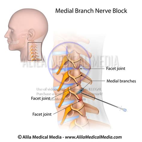 Alila Medical Media | Cervical medial branch block. | Medical illustration