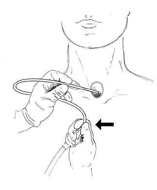 Laryngectomy Home Care Booklet | Iowa Head and Neck Protocols