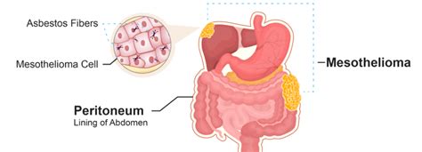 Peritoneal Mesothelioma | Symptoms, Treatment & Survival