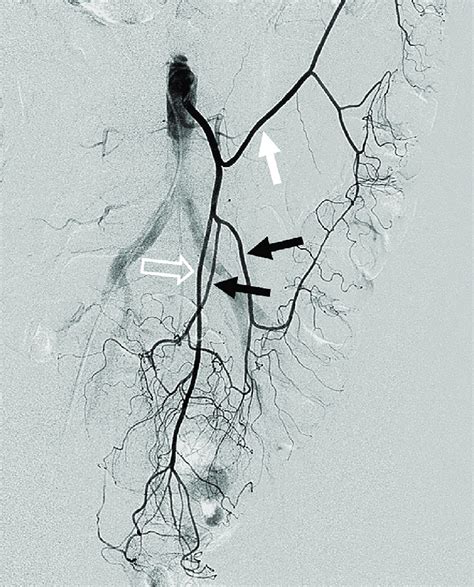 Inferior mesenteric angiogram for suspected active bleeding from a... | Download Scientific Diagram