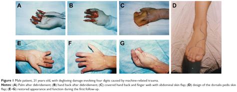 Treatment of degloving injury involving multiple fingers with combined | TCRM