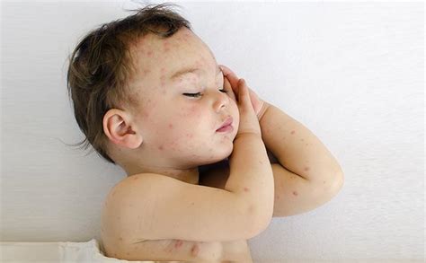 5 Effective Treatments To Cure Baby Bug Bites