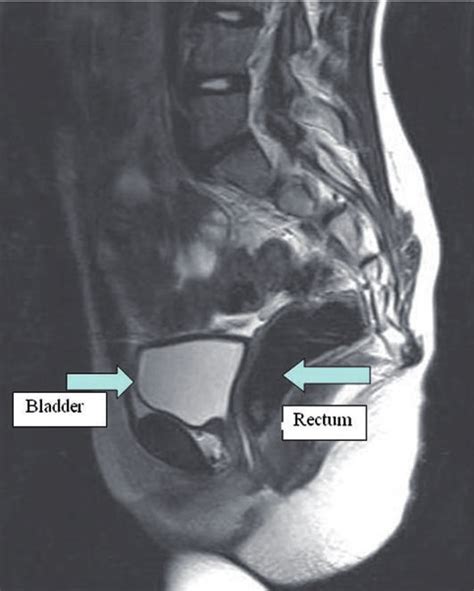 Absence of the uterus in the MRI scan. | Download Scientific Diagram