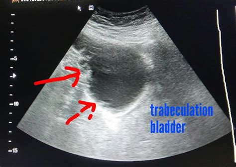 Ultrasound imaging: Urinary-bladder-trabeculation-3D-ultrasound