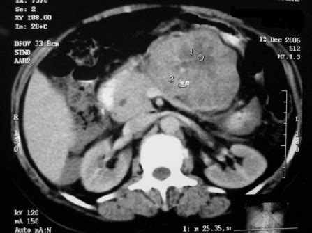 A contrast-enhanced CT scan of the pancreas showing a mass in the... | Download Scientific Diagram