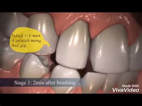 Proses Pembentukan Plak (dental plaque) - YouTube